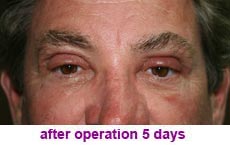 plastic-surgery-blepharoplasty